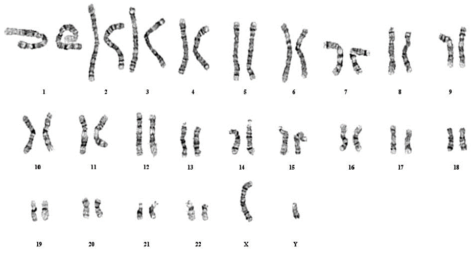 angelman syndrome chromosome