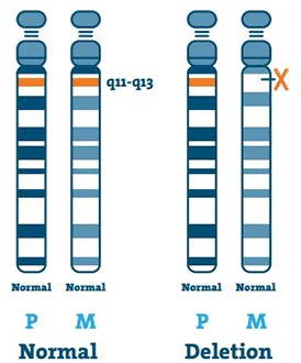 Angelman Syndrome type: Deletion