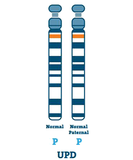 Angelman syndrome type: Uniparental Disomy